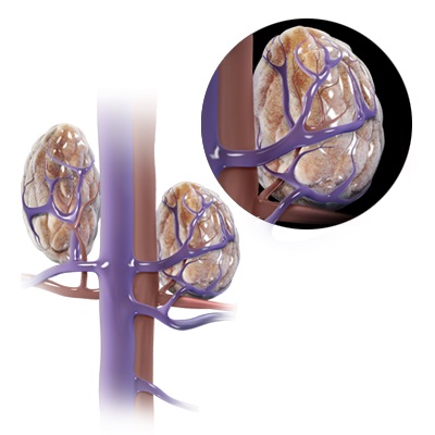 Cushing’s disease